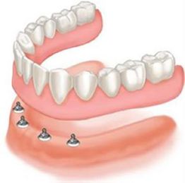 Illustration of a full upper dental arch with implants on a lower gum for denture support.