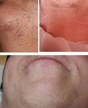 Nahaufnahme eines Kinns mit Haaren vor und nach der Haarentfernung mit unterschiedlichen Lichtverhältnissen.