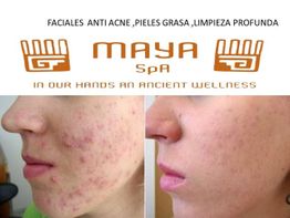 Rostros antes y después de tratar acné en un spa, mostrando piel más clara. Promoción de Maya Spa.