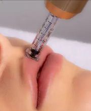 Labios siendo inyectados con jeringa durante procedimiento estético en un entorno médico.