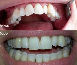 Bocca umana con denti: sopra "Prima", sotto "Dopo" trattamento dentale.