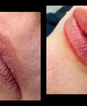 Links: naturel lippen, rechts: getinte lippen na behandeling.