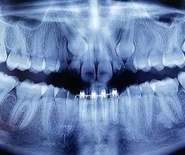 Radiografia dentale che mostra arcate e impianti nella mascella inferiore.