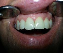 Sorriso con denti bianchi esposti, riflessi su due specchietti dentali ai lati.