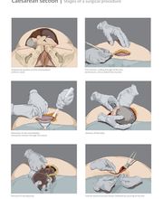 Proben | C-Schnitt Operation