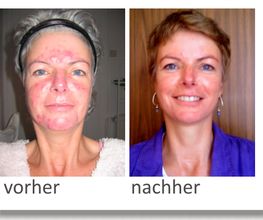 vorher / nachher Aknebehnadlung