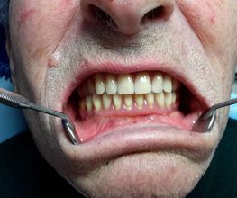 Viso di uomo mentre un dentista esamina le gengive con strumenti odontoiatrici.