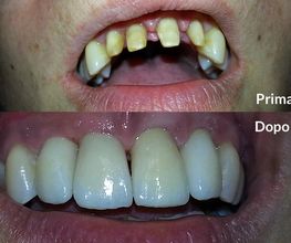 Sorriso prima e dopo la ricostruzione dentale, mostrando un notevole miglioramento dei denti.