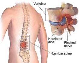 Diagram of a herniated disc and pinched nerve in the lumbar spine, highlighting the vertebra.