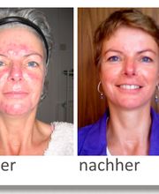 vorher / nachher Aknebehnadlung