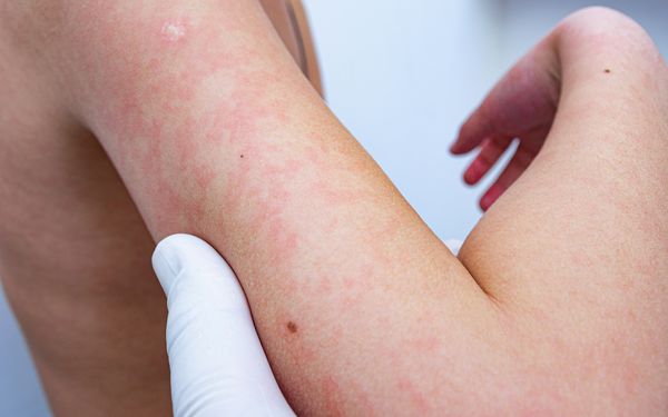 Der Arm eines Kindes ist stellenweise gerötet, da es sich mit einem allergischen Ausschlag infiziert hat.