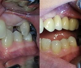 Bocca con denti mancanti a sinistra, denti riparati con protesi a destra.